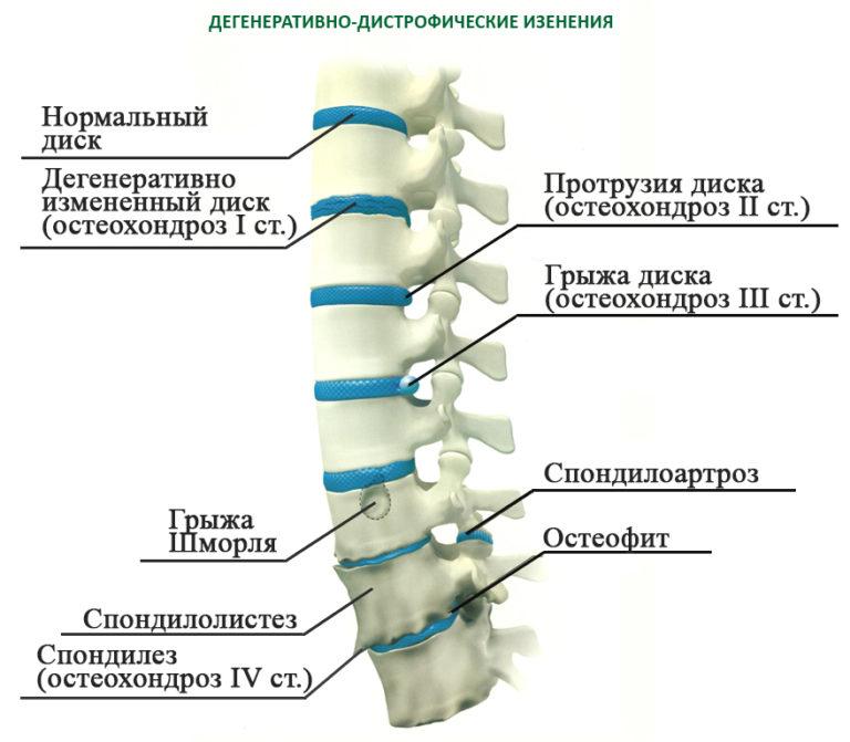 Дорсопатия на фоне распространенного остеохондроза