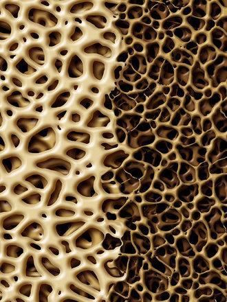 Виды остеопороза